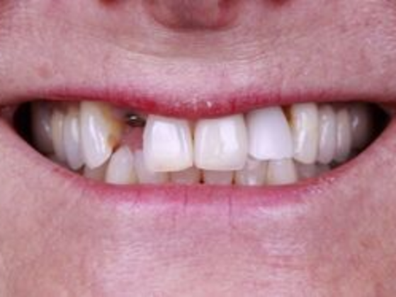 Smile Transformations Case 8 - Before