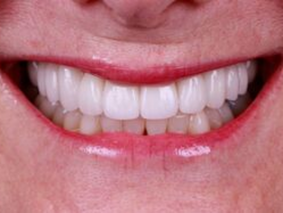 Smile Transformations Case 8 - After