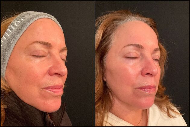 Laser Skin Rejuvenation & Brown Spot Removal: Photofacial & Fractional Resurfacing, Fair Haven, NJ - After