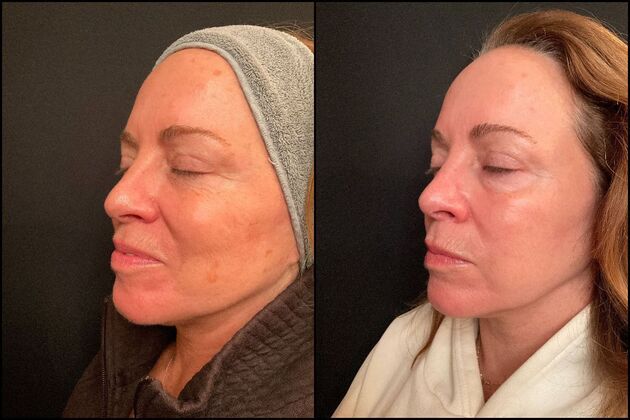 Laser Skin Rejuvenation & Brown Spot Removal Photofacial & Fractional Resurfacing, Fair Haven, NJ
