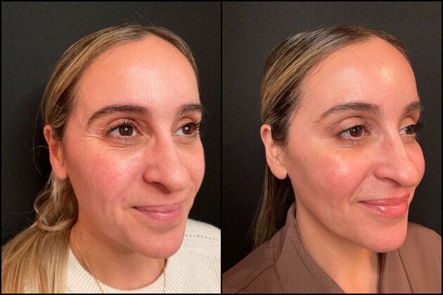 Daxxify: A Botox alternative for Wrinkles  Daxxify Wrinkle Treatment for Crows Feet, Fair Haven, NJ