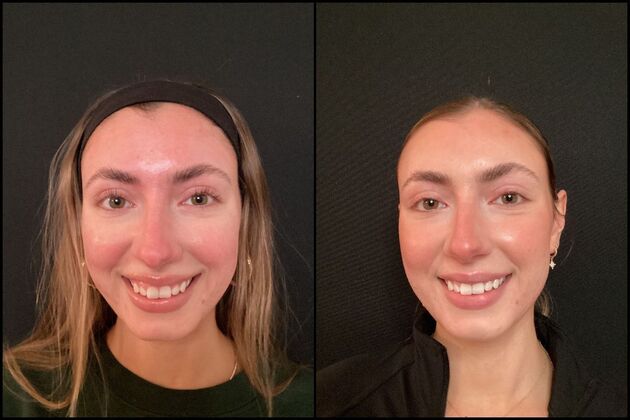 Xeomin Wrinkle Relaxers: A Botox Alternative Non-Surgical Gummy Smile Correction, Shrewsbury, NJ