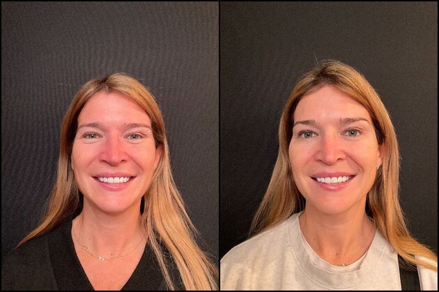 Xeomin Wrinkle Relaxers: A Botox Alternative Cases