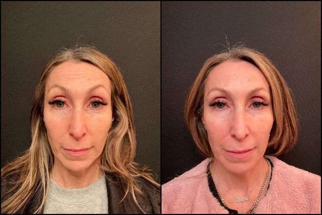 Xeomin Wrinkle Relaxers: A Botox Alternative Xeomin Wrinkle Relaxers in the Forehead, Rumson, NJ