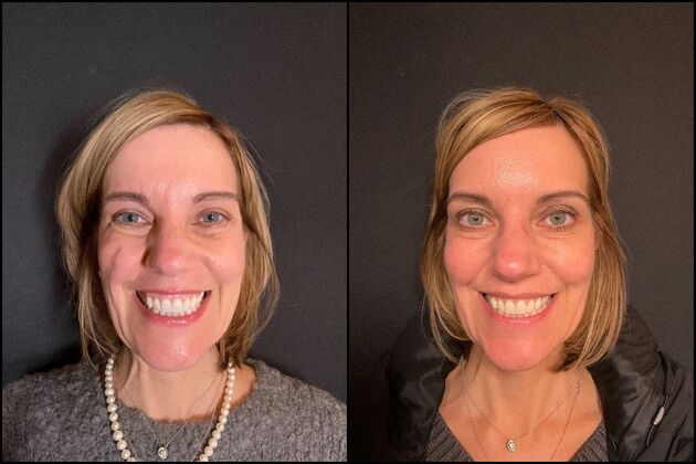 Daxxify: A Botox alternative for Wrinkles Cases