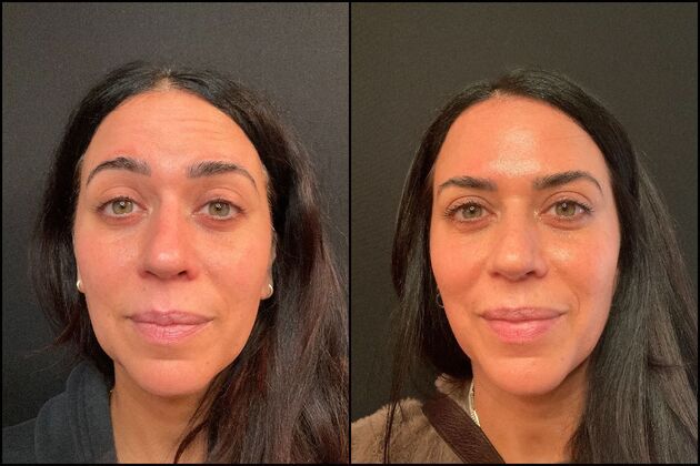 Xeomin Wrinkle Relaxers: A Botox Alternative Xeomin Wrinkle Relaxer Upper Forehead and Frown Lines Face, Rumson, NJ
