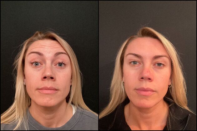 Xeomin Wrinkle Relaxers: A Botox Alternative: Xeomin Baby Botox for Gummy Smile Correction & Forehead Lines, Atlantic Highlands, NJ - Before & After 