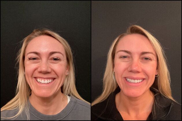 Xeomin Wrinkle Relaxers: A Botox Alternative Xeomin Baby Botox for Gummy Smile Correction & Forehead Lines, Atlantic Highlands, NJ