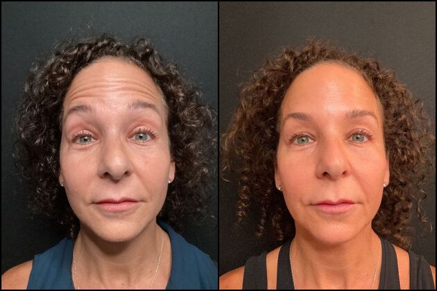 Daxxify: A Botox alternative for Wrinkles  Daxxify Wrinkle Reduction Treatment Forehead and Frown Lines, Middletown, NJ
