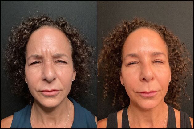 Daxxify: A Botox alternative for Wrinkles : Daxxify Wrinkle Reduction Treatment Forehead and Frown Lines, Middletown, NJ - Before & After 