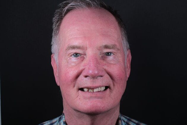 Removable Dentures: Case 22 - Before