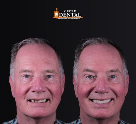 Removable Dentures Case 22