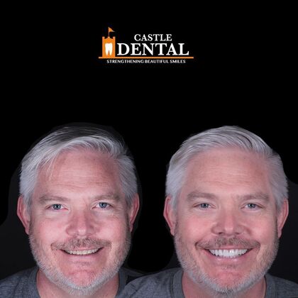 Porcelain Veneers Case 1