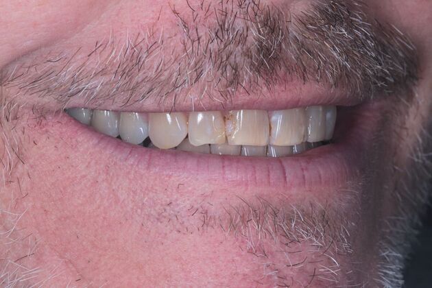 Porcelain Veneers: Case 1 - Before