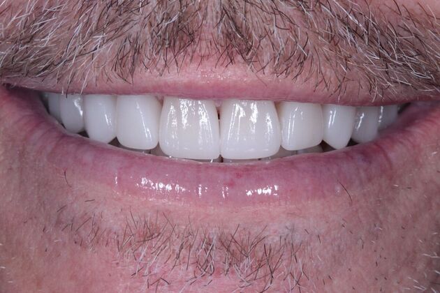 Porcelain Veneers: Case 1 - After