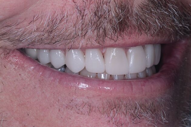 Porcelain Veneers: Case 1 - After