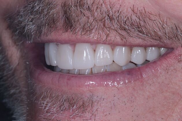 Porcelain Veneers: Case 1 - After