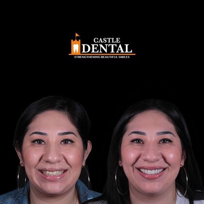 Porcelain Veneers Case 5