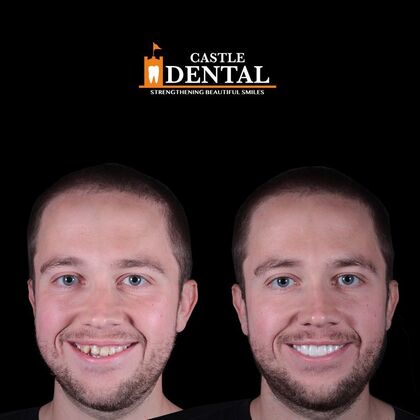 Zirconia Crowns Case 13