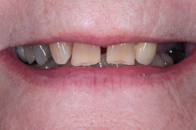 Zirconia Crowns: Case 4 - Before