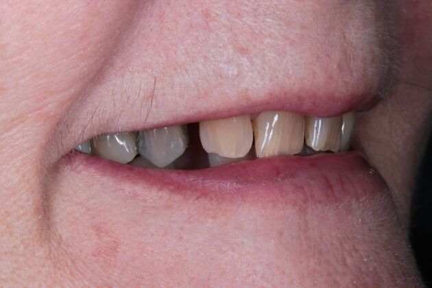Zirconia Crowns: Case 4 - Before