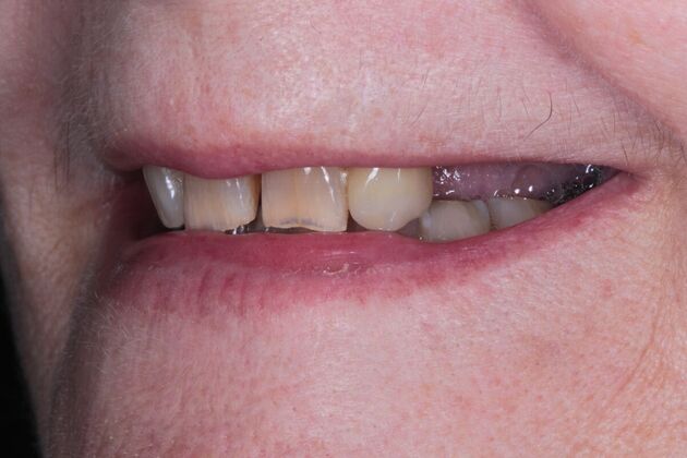 Zirconia Crowns: Case 4 - Before