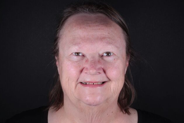 Zirconia Crowns: Case 4 - Before