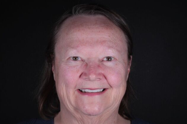 Zirconia Crowns: Case 4 - After