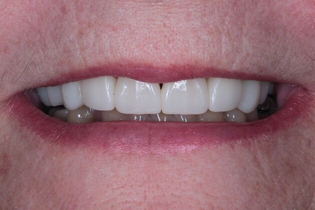 Zirconia Crowns: Case 4 - After