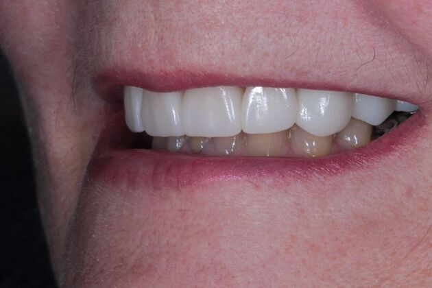 Zirconia Crowns: Case 4 - After