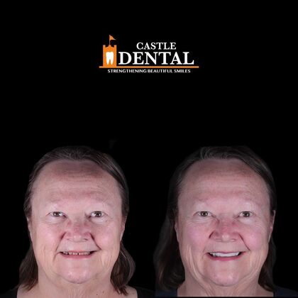 Zirconia Crowns Case 4