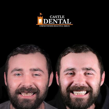 Zirconia Crowns Case 21