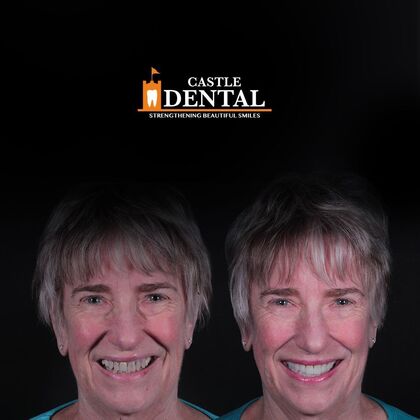 Full Mouth Restoration  Case 11