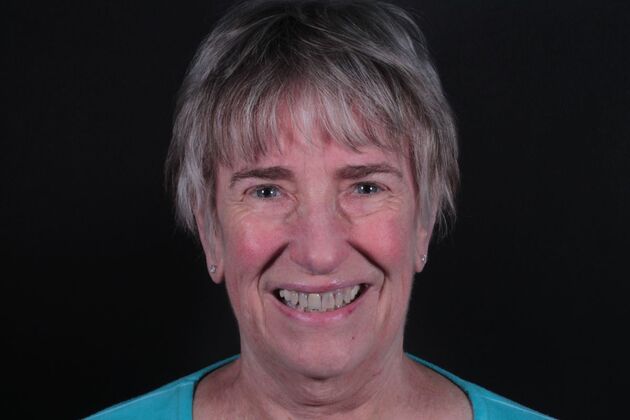 Full Mouth Restoration : Case 11 - Before