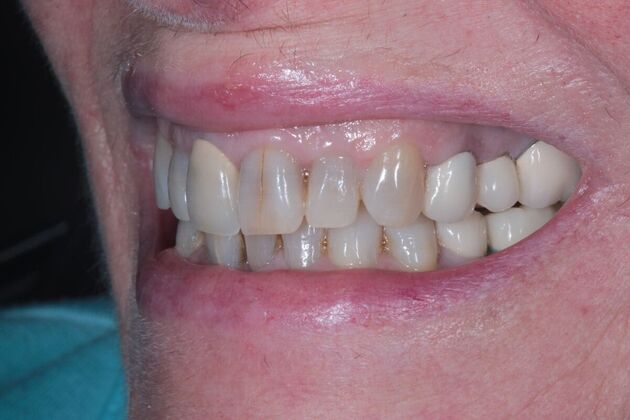 Full Mouth Restoration : Case 11 - Before