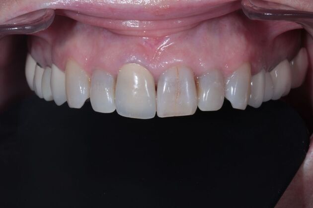Full Mouth Restoration : Case 11 - Before