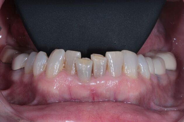 Full Mouth Restoration : Case 11 - Before