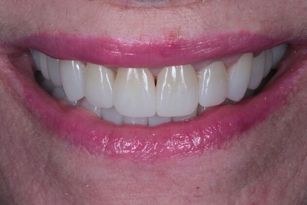 Full Mouth Restoration : Case 11 - After