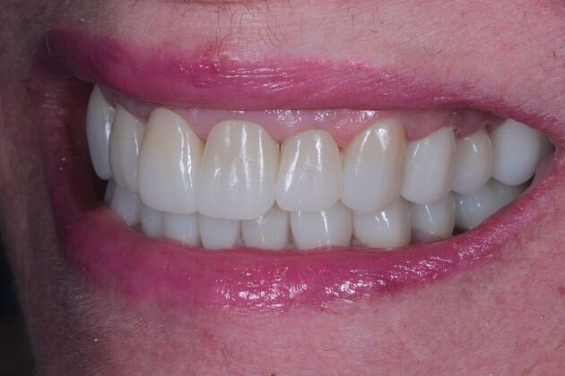 Full Mouth Restoration : Case 11 - After