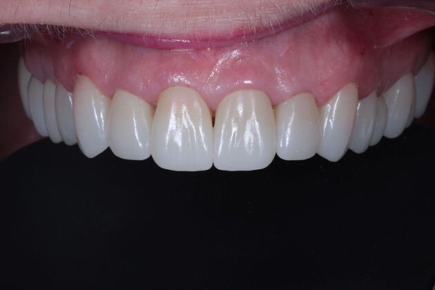 Full Mouth Restoration : Case 11 - After