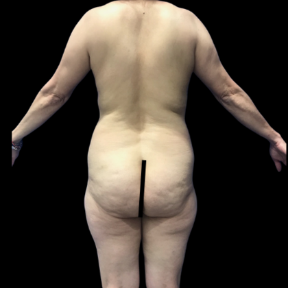 Brazilian Butt Lift: Case 33 - Before