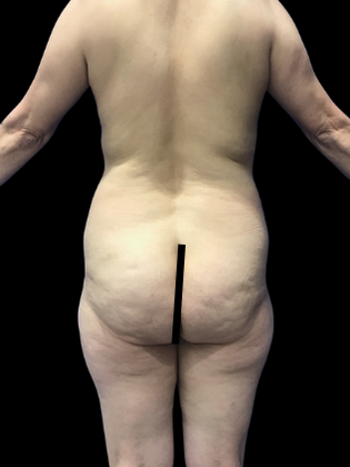 Brazilian Butt Lift BBL 21 - Before