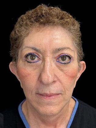 Blepharoplasty Case 4 - After