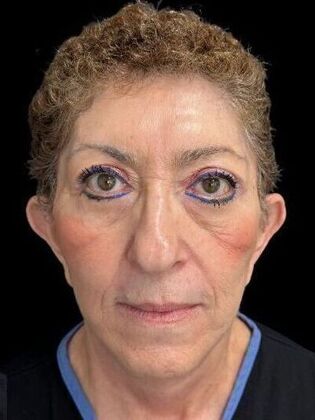 Blepharoplasty Blepharoplasty 3 - After