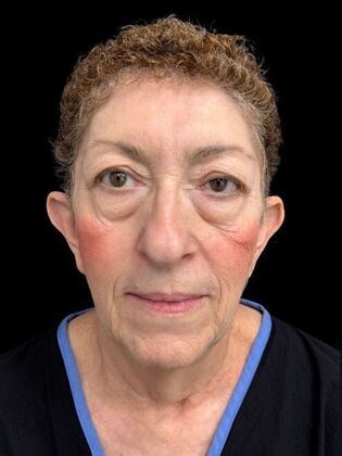 Blepharoplasty Case 4 - Before