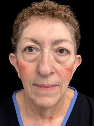 Blepharoplasty Blepharoplasty 3 - Before
