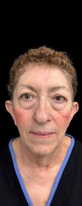 Face & Neck Lifts Case 3 - Before