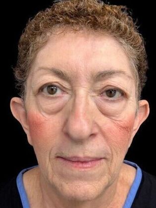 Face & Neck Lifts Facelift 2 - Before