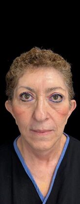 Face & Neck Lifts Case 3 - After