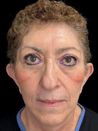 Face & Neck Lifts Facelift 2 - After